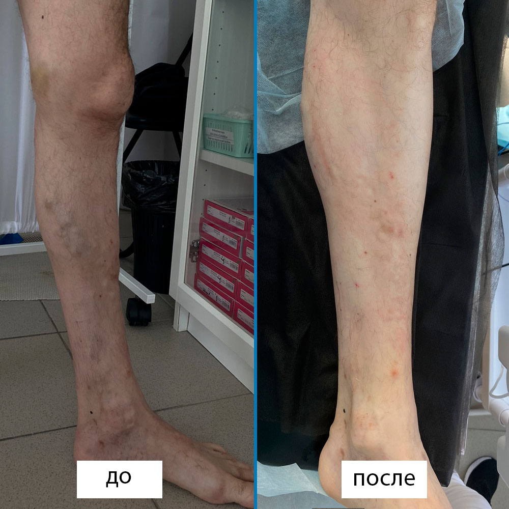 Результаты лазерного лечения варикоза (ЭВЛК) и склеротерапии на голени. Фото "После" сделано сразу после лечения.