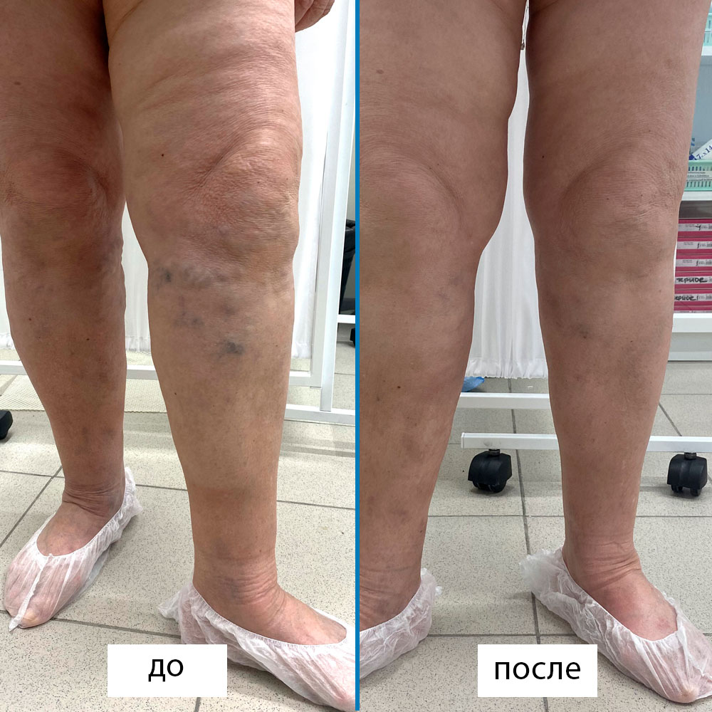 Результаты лазерного лечения варикоза больших подкожных вен на обеих ногах. Время проведения 50 мин. 